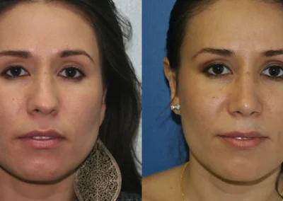 rhinoplasty before and after photo by reichner plastic surgery in orange ca