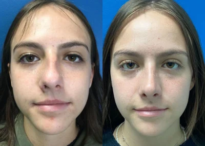 rhinoplasty before and after photo by reichner plastic surgery in orange ca