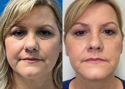 rhinoplasty before and after photo by reichner plastic surgery in orange ca