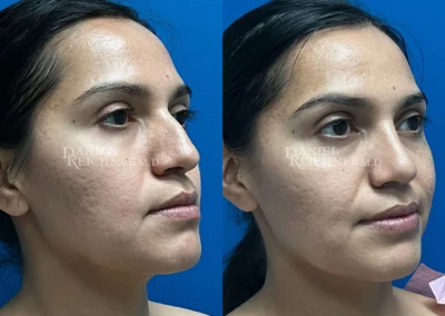 rhinoplasty before and after photo by reichner plastic surgery in orange ca