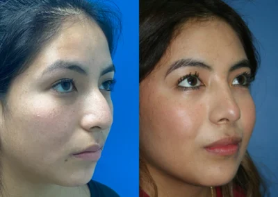 rhinoplasty before and after photo by reichner plastic surgery in orange ca