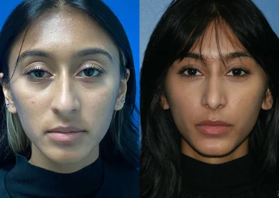 rhinoplasty before and after photo by reichner plastic surgery in orange ca