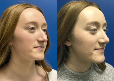 rhinoplasty before and after photo by reichner plastic surgery in orange ca