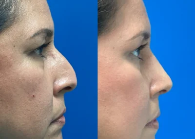 rhinoplasty before and after photo by reichner plastic surgery in orange ca