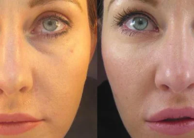 juvederm before and after photo by reichner plastic surgery in orange ca