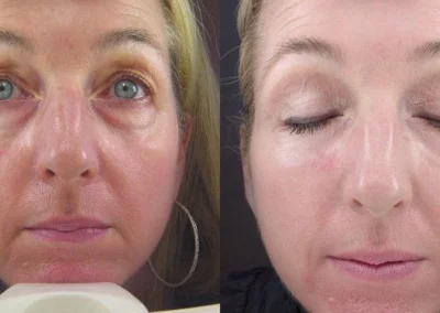 juvederm before and after photo by reichner plastic surgery in orange ca