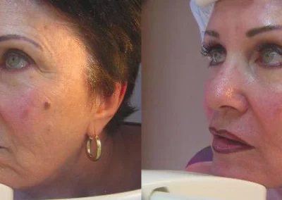 laser resurfacing before and after photo by reichner plastic surgery in orange ca