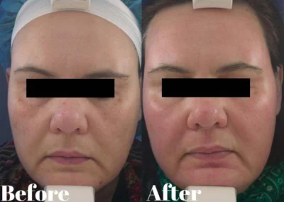 laser resurfacing before and after photo by reichner plastic surgery in orange ca