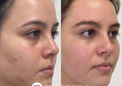 laser resurfacing before and after photo by reichner plastic surgery in orange ca