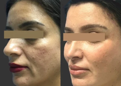 laser resurfacing before and after photo by reichner plastic surgery in orange ca