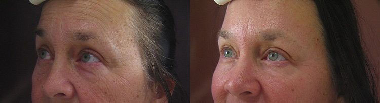 laser resurfacing before and after photo by reichner plastic surgery in orange ca