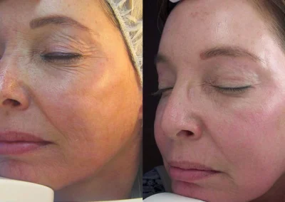 laser resurfacing before and after photo by reichner plastic surgery in orange ca