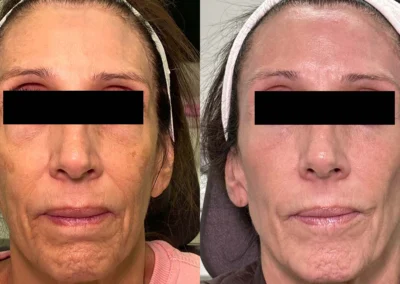 laser resurfacing before and after photo by reichner plastic surgery in orange ca