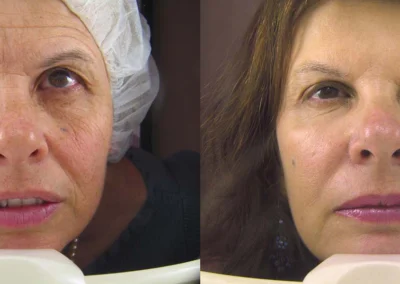 laser resurfacing before and after photo by reichner plastic surgery in orange ca