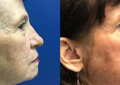 laser resurfacing before and after photo by reichner plastic surgery in orange ca