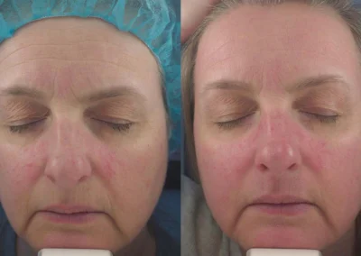 laser resurfacing before and after photo by reichner plastic surgery in orange ca