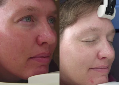 photofacial ipl before and after photo by reichner plastic surgery in orange ca