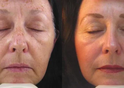 photofacial ipl before and after photo by reichner plastic surgery in orange ca