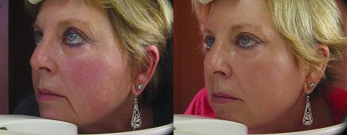 photofacial ipl before and after photo by reichner plastic surgery in orange ca