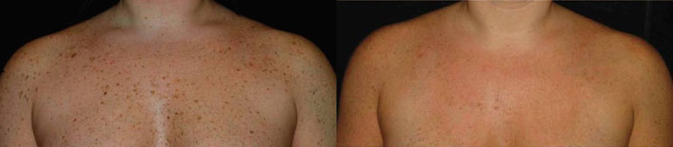 photofacial ipl before and after photo by reichner plastic surgery in orange ca