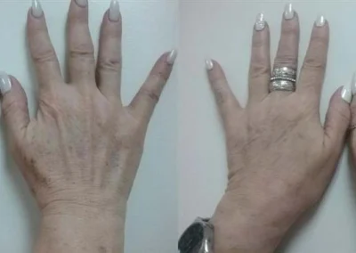 photofacial ipl before and after photo by reichner plastic surgery in orange ca