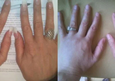 radiesse before and after photo by reichner plastic surgery in orange ca