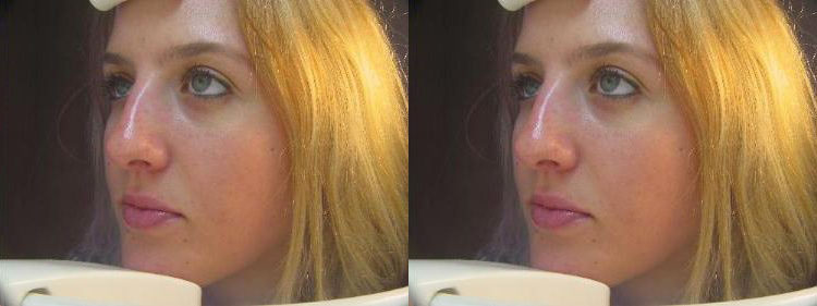 scar treatment before and after photo by reichner plastic surgery in orange ca