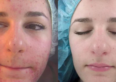 scar treatment before and after photo by reichner plastic surgery in orange ca