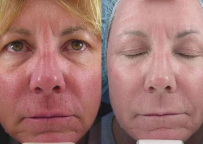 sculptra before and after photo by reichner plastic surgery in orange ca