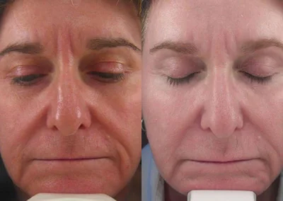 sculptra before and after photo by reichner plastic surgery in orange ca
