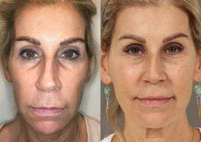 sculptra before and after photo by reichner plastic surgery in orange ca