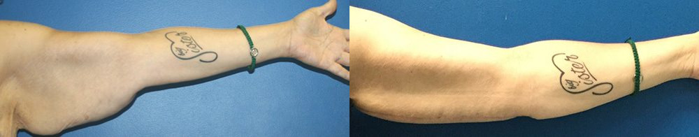 arm lift before and after photo by reichner plastic surgery in orange ca