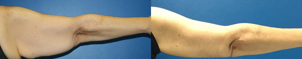 arm lift before and after photo by reichner plastic surgery in orange ca
