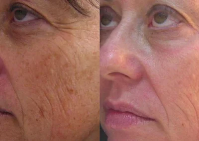 skin rejuvenation before and after photo by reichner plastic surgery in orange ca