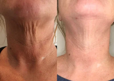 skin rejuvenation before and after photo by reichner plastic surgery in orange ca