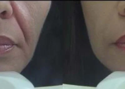 restylane before and after photo by reichner plastic surgery in orange ca