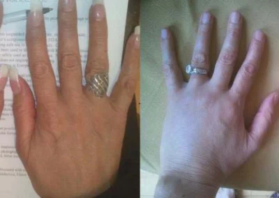 restylane before and after photo by reichner plastic surgery in orange ca