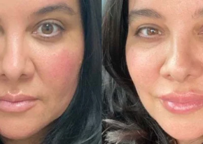 restylane before and after photo by reichner plastic surgery in orange ca
