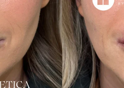 restylane before and after photo by reichner plastic surgery in orange ca