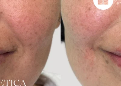 restylane before and after photo by reichner plastic surgery in orange ca