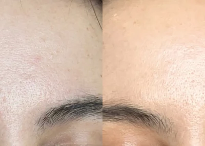 rf microneedling before and after photo by reichner plastic surgery in orange ca