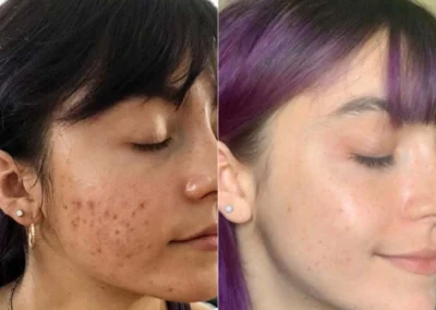 rf microneedling before and after photo by reichner plastic surgery in orange ca