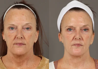 obagi nu derm system before and after photo by reichner plastic surgery in orange ca ()