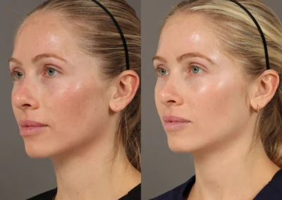 obagi nu derm system before and after photo by reichner plastic surgery in orange ca