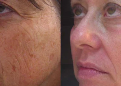 obagi nu derm system before and after photo by reichner plastic surgery in orange ca