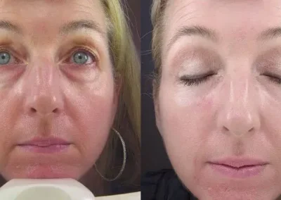 obagi nu derm system before and after photo by reichner plastic surgery in orange ca