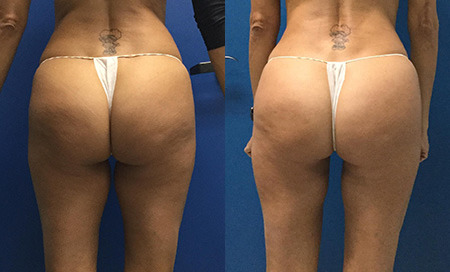 brazilian butt lift before and after photo by reichner plastic surgery in orange ca