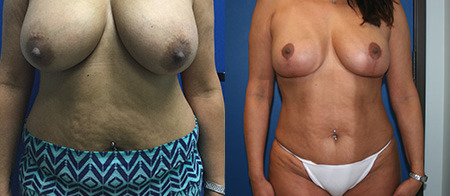 liposuction before and after photo by reichner plastic surgery in orange ca