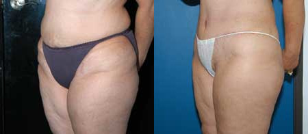 liposuction before and after photo by reichner plastic surgery in orange ca
