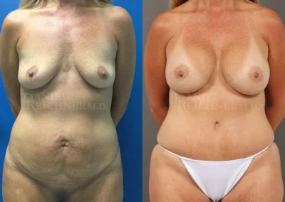mommy makeover before and after photo by reichner plastic surgery in orange ca
